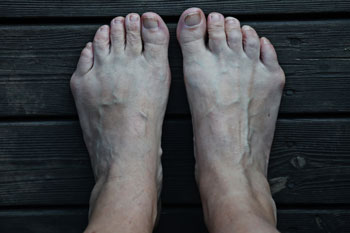 Bunions Treatment, surgery and recovery in the Broward County, FL: Tamarac (Margate, Palm Aire, Coral Springs, Parkland, Coconut Creek, Sunrise, Lauderdale Lakes, Plantation, Lauderhill, Oakland Park, Wilton Manors, Pompano Beach, Hollywood, West Park, Miramar, Hallandale Beach) and Miami-Dade County, FL: North Miami Beach (Opa-locka, Westview, Palm Springs North, Miami Lakes, Miami Gardens, Aventura) and Miami (Fisher Island, Miami Beach, Coral Gables, Westchester, Hialeah, Key Biscayne, Fontainebleau) areas
