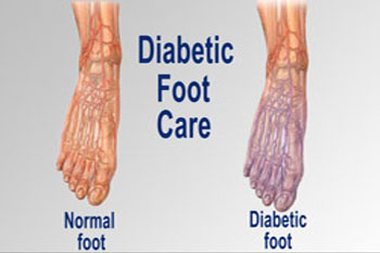 Diabetic foot treatment, diabetic wounds and ulcers treatment in the Broward County, FL: Tamarac (Margate, Palm Aire, Coral Springs, Parkland, Coconut Creek, Sunrise, Lauderdale Lakes, Plantation, Lauderhill, Oakland Park, Wilton Manors, Pompano Beach, Hollywood, West Park, Miramar, Hallandale Beach) and Miami-Dade County, FL: North Miami Beach (Opa-locka, Westview, Palm Springs North, Miami Lakes, Miami Gardens, Aventura) and Miami (Fisher Island, Miami Beach, Coral Gables, Westchester, Hialeah, Key Biscayne, Fontainebleau) areas