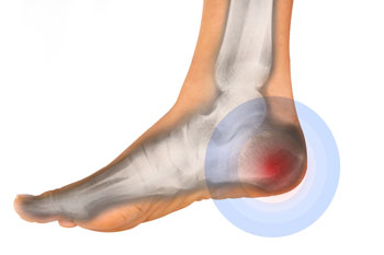 Heel pain diagnosis and treatment in the Broward County, FL: Tamarac (Margate, Palm Aire, Coral Springs, Parkland, Coconut Creek, Sunrise, Lauderdale Lakes, Plantation, Lauderhill, Oakland Park, Wilton Manors, Pompano Beach, Hollywood, West Park, Miramar, Hallandale Beach) and Miami-Dade County, FL: North Miami Beach (Opa-locka, Westview, Palm Springs North, Miami Lakes, Miami Gardens, Aventura) and Miami (Fisher Island, Miami Beach, Coral Gables, Westchester, Hialeah, Key Biscayne, Fontainebleau) areas